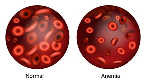 alemia|Anemia